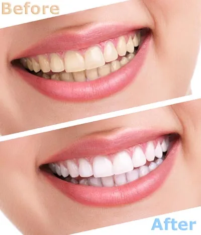 before and after look at the professional teeth whitening results Stonebriar Family Dentistry offers